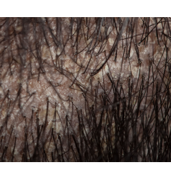 How to Care for Sisterlocks With Seborrheic Dermatitis